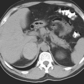 CT imaging of the right adrenal gland