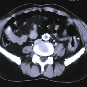 Ischaemic colitis: CT after pneumocolon and administration of contrast medium i.v.