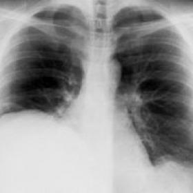 Radiograph of the chest