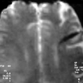 GE T2*- WI and contrast- enhanced T1 - WI at the level of the lateral ventricles