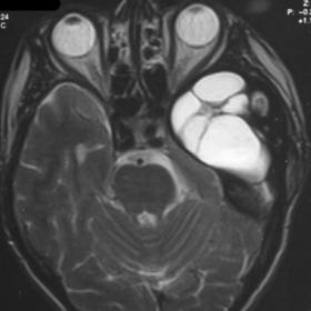 MRI pictures