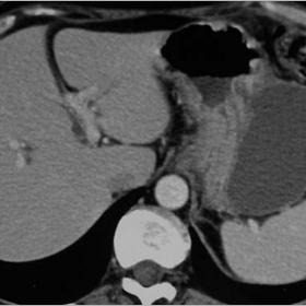 h-CT demonstrating the presence of three fluid collections in the peripancreatic area, adjacent to the stomach