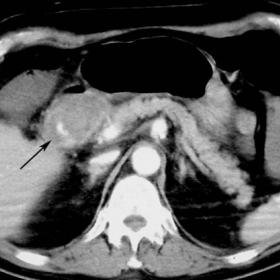 CT image shows an extravasation of the contrast medium