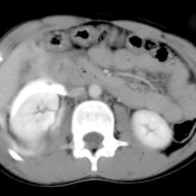 CT Scan following IV contrast adminstration (excretory phase). The examination performed on the night of admission. Extravasated contrast from the torn renal pelvis surrounds the right kidney. Note the thick-walled colon lying just deep to the anterior abdominal wall. Free fluid is interposed between the oedematous colon and the injuried right kidney.