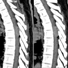 Spine CT - axial and sagittal reformatations.