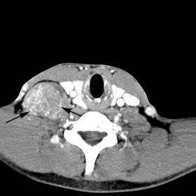 CT image after intravenous injection of contrast medium