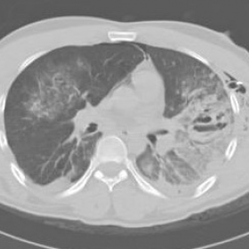 CT image of the thorax