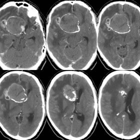 Brain CT with contrast