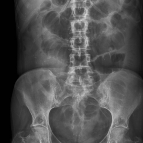 Plain abdominal radiograph at admission.