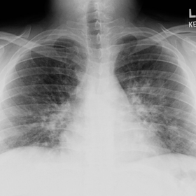 Frontal and lateral chest radiographs.