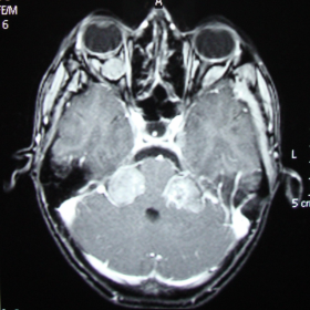 Axial T1-weighted post contrast MRI