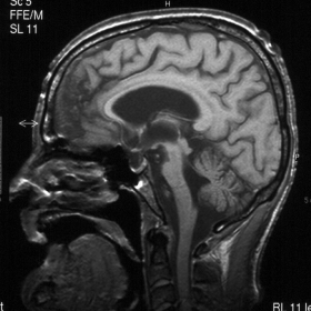 Sagittal T1-weighted MRI