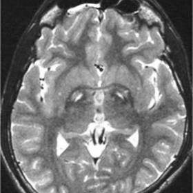 Axial T2-weighted MRI