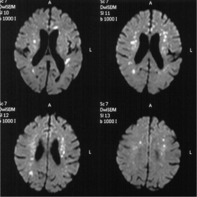 Diffusion weighted MRI