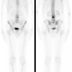 Whole body planar images from Technetium-99 MDP bone scintigraphy.