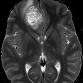 a) Axial, b) sagital pre-contrast brain MRI scan (T2WI)
