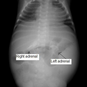 Calcified adrenals (abdominal X-ray)