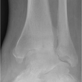 Anteroposterior radiograph of the left ankle