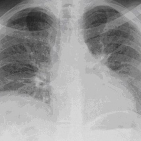 Chest radiograph