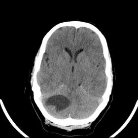 Non-enhanced CT brain