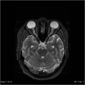 Axial fat-suppressed T2W MRI