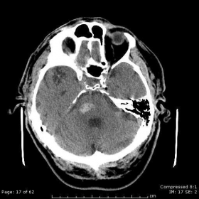 Axial CT images without contrast