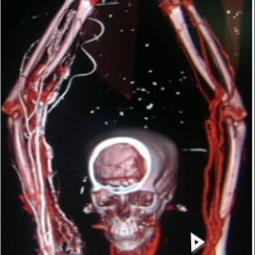 Stenosis at brachial vein (arrowheads)