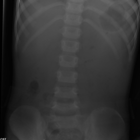 X-ray Abdomen