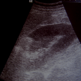 Gas detected on ultrasonography shows up as a dirty shadow