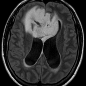 Pre-operative brain MRI (axial FLAIR image)