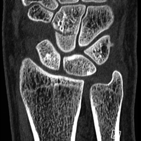 Coronal and sagittal CT images of the left wrist