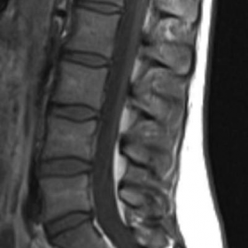 Sagittal T1, T2, and fat suppressed T2 of lumbar spine