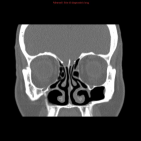 Coronal view of the maxillary sinus region