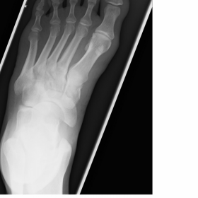 Plain radiograph of left foot