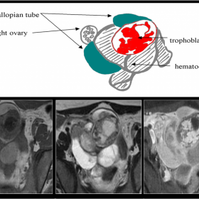 MRI features of chronic ectopic pregnancy