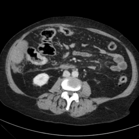 Contrast-enhanced abdominal CT