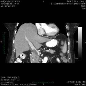 Thrombus within the SMV extending to the VP