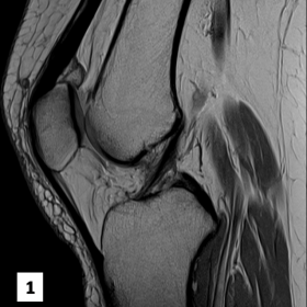 Sagittal proton density image of the left knee