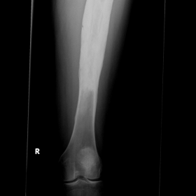 Left femoral X-ray distal