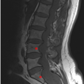 Sagittal T1 weighted MR image of the lumbosacral spine