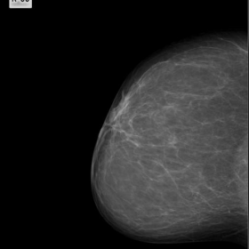 Mammography 4 - RCC