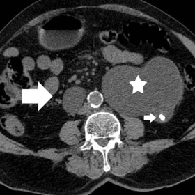 CT urography, plain images