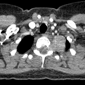 CT after contrast injection