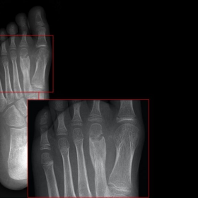 Oblique left foot radiograph