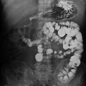 Plain abdominal X-rays