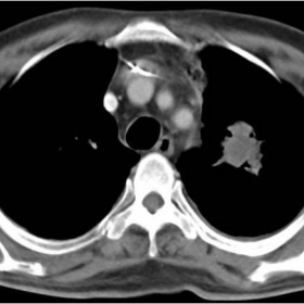 Parenchymal nodular lesions in initial CECT chest