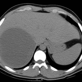 Adrenal pseudocyst