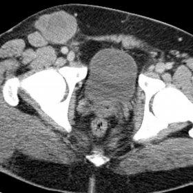 Contrast enhanced axial CT pelvis