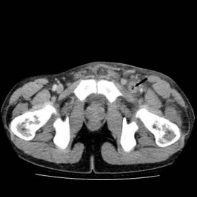 Axial-CT showing infected thrombus in the left external iliac vein