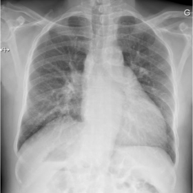 Chest X-ray demonstrating cardiomegaly and elevated right hemidiaphragm